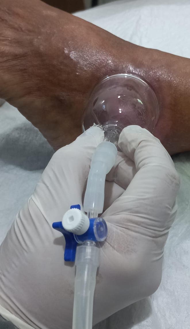 Ozonioterapia - foto 4